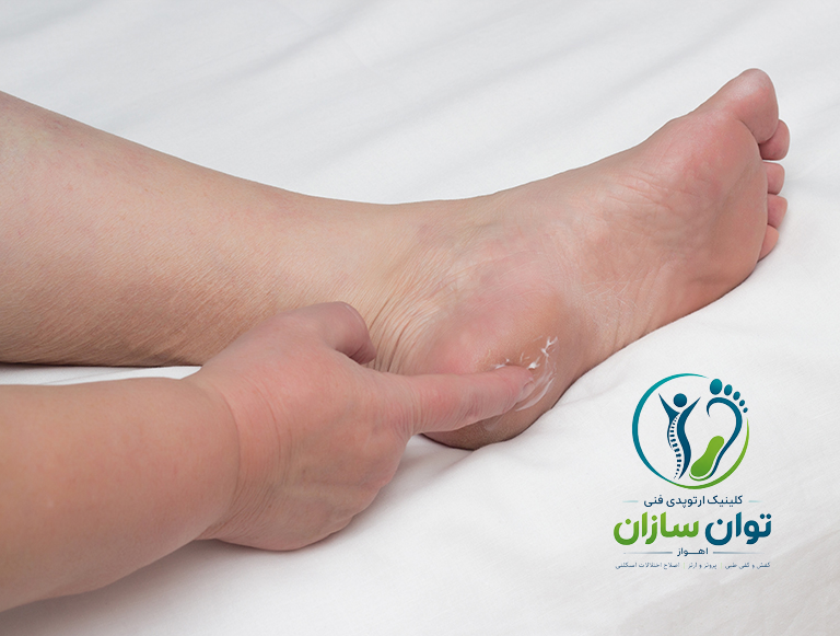 خار پاشنه در اهواز